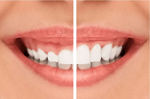 Gingivectomie au Laser